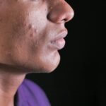 Side view close-up of a young man's face with visible acne on cheek and jawline.